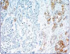 Гетерогенное окрашивание клеток опухоли желудка, экспрессирующих HER2
