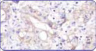 Слабое/едва различимое частичное мембранное окрашивание в ≥10%опухолевых клеток