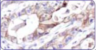 Слабое/умеренное полное, базолатеральное или латеральное мембранное окрашивание в ≥10% опухолевых клеток