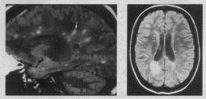 Рис. 2, 3. Типичное расположение очагов РС на МР-томограммах.