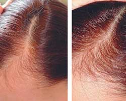 Применение препарата «Пантовигар» для лечения диффузного телогенного выпадения волос у женщин