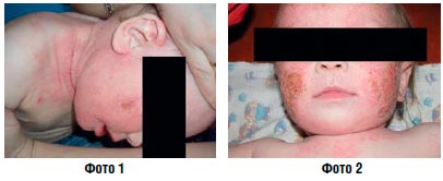 Атопический дерматит у детей наружная терапия thumbnail